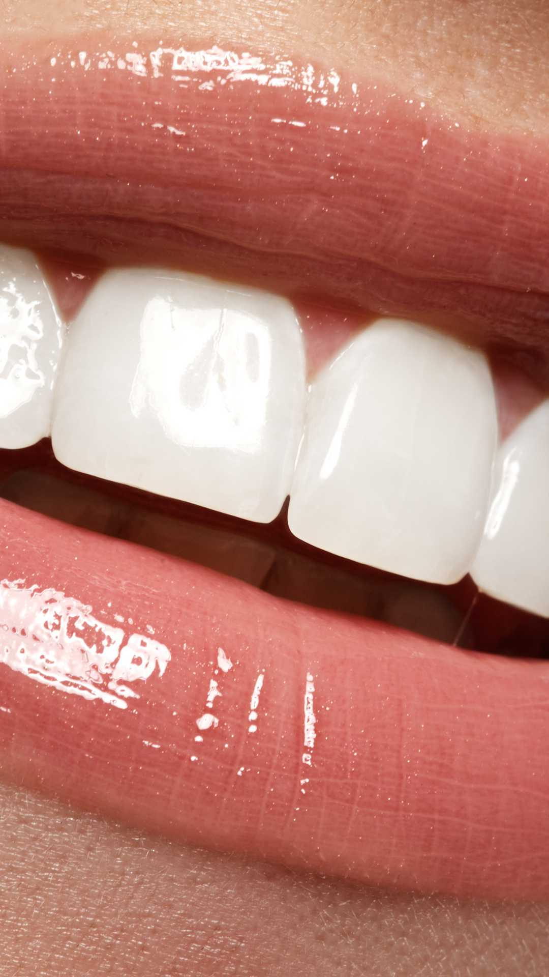 Aesthetic bright smile following veneer application