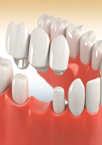 Dental Crowns & Bridges