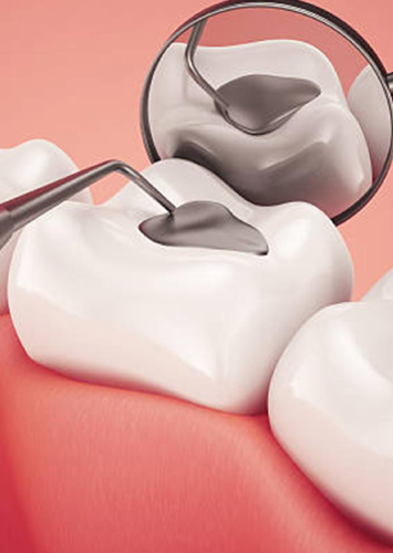 Dental Fillings