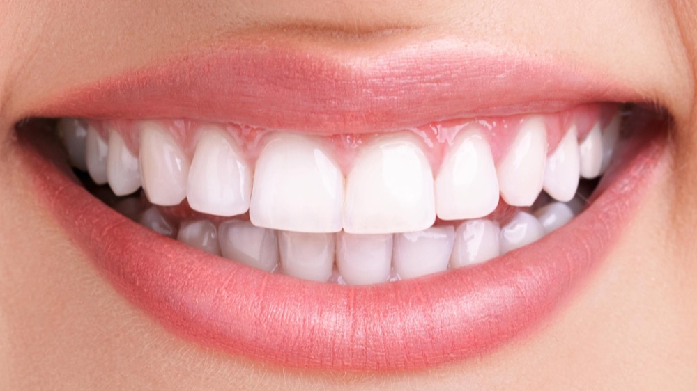 Teeth after restoration treatment at Adelaide Dental Spa