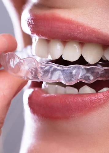 Invisalign / Clear aligners