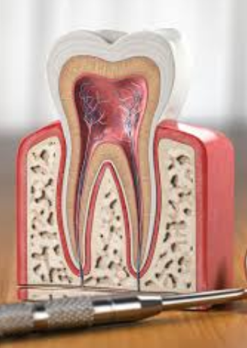 Root Canal Therapy