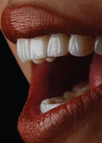 Veneers