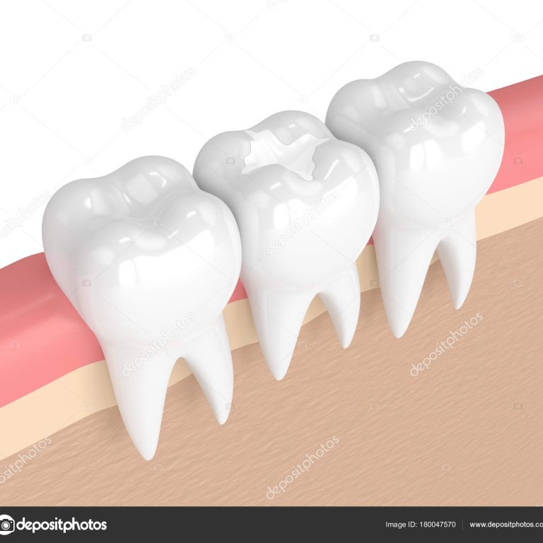 3d render of teeth with dental composite filling in gums