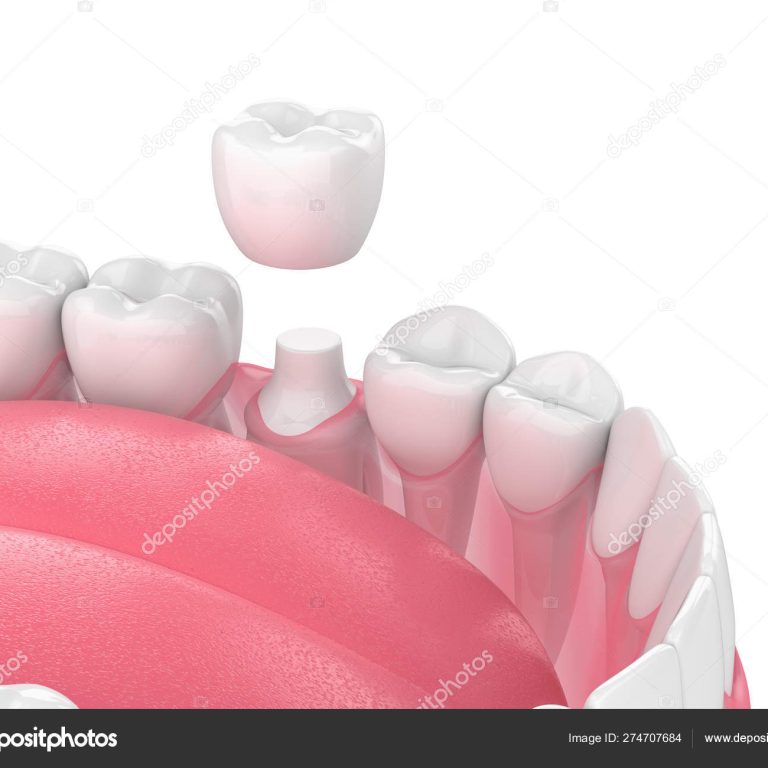 3d render of jaw with teeth and dental crown restoration over white background