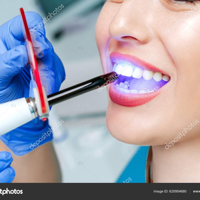 Doctor dentist whiten teeth to young attractive patient woman in stomotology clinic. Hands doctor dentist with medical tools. Healthy teeth concept