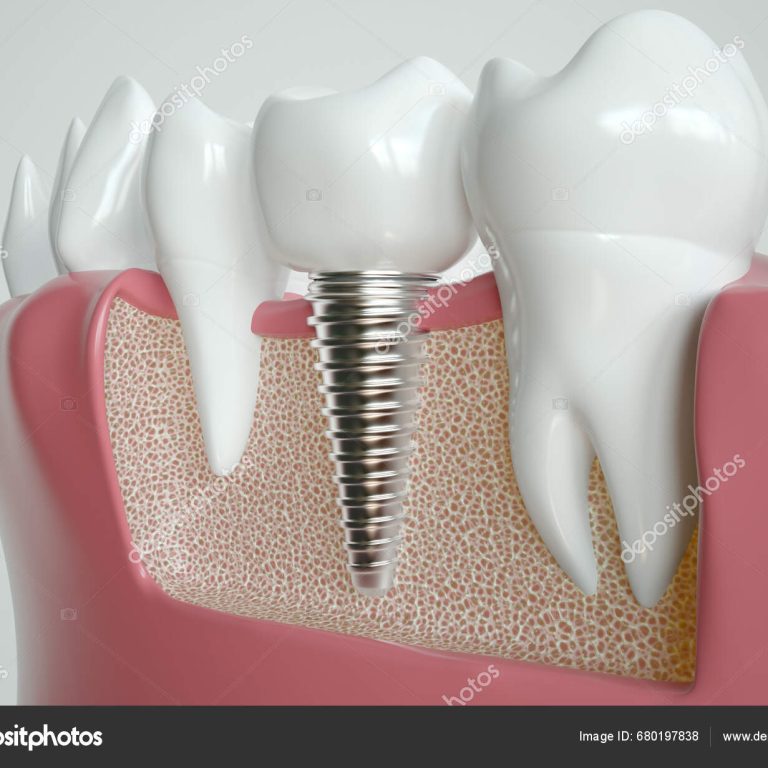 depositphotos_680197838-stock-photo-dental-implant-nestled-two-healthy
