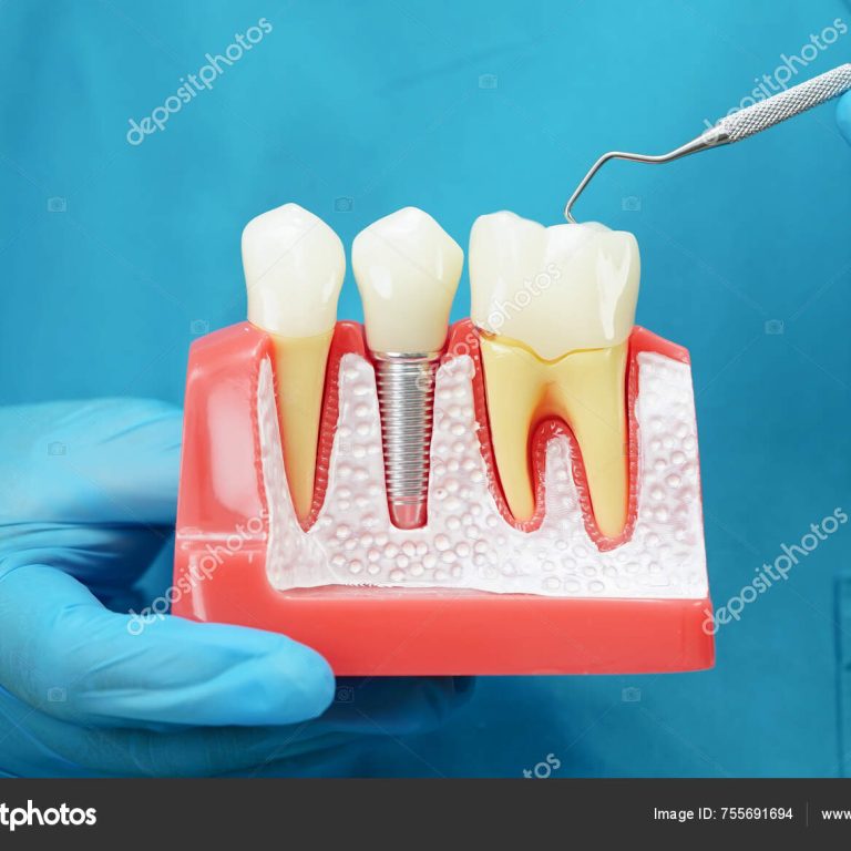 depositphotos_755691694-stock-photo-dentist-holding-dental-implant-artificial